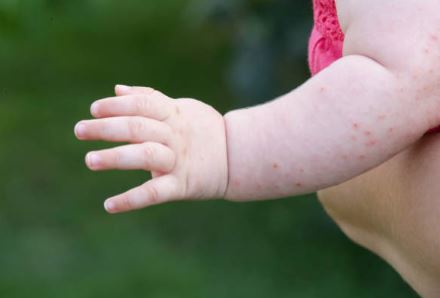 Mabisang gamot sa kagat ng insekto sa Baby