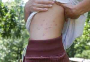 Home Remedy sa Kagat ng Surot - Gamot sa Kagat