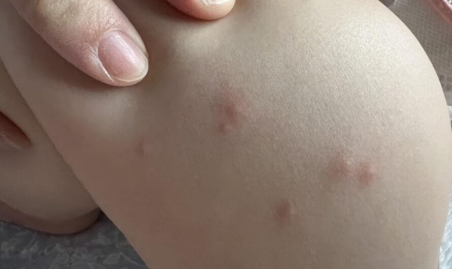 Gamot sa Kagat ng Langgam sa Baby: Sanhi, Sintomas, at Paggamot