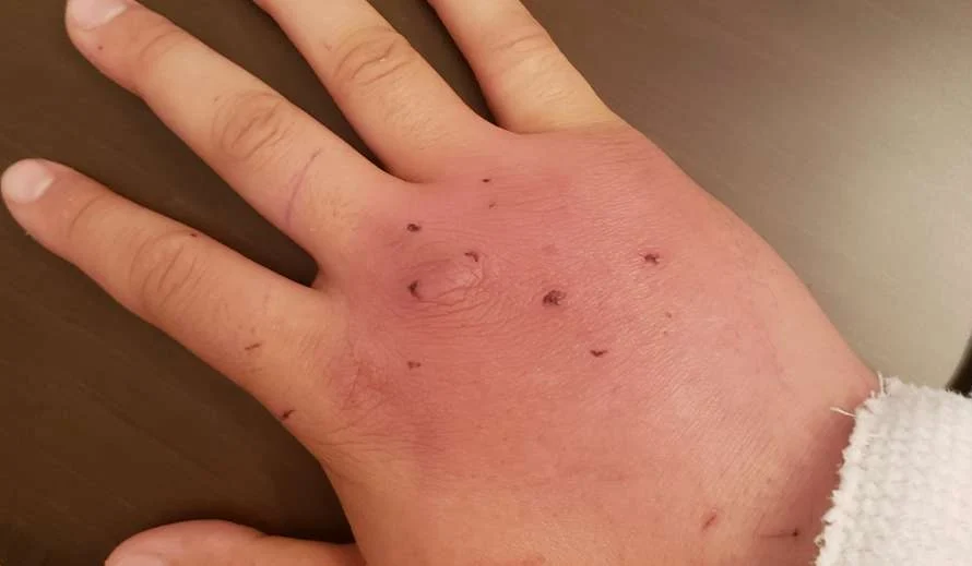 Kailangan ba ng Anti-Tetanus sa Kagat ng Pusa?